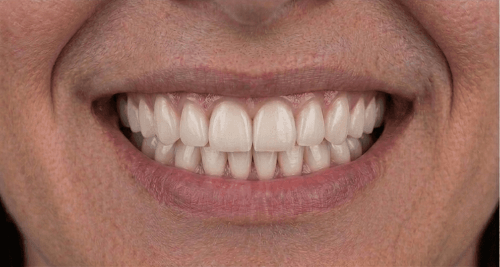 Before veneer treatment