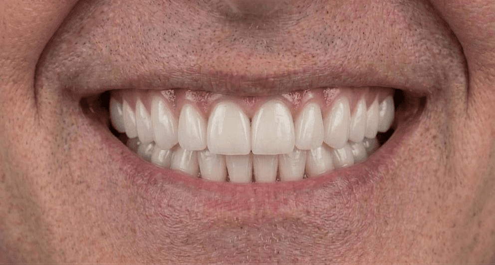 Before veneer treatment