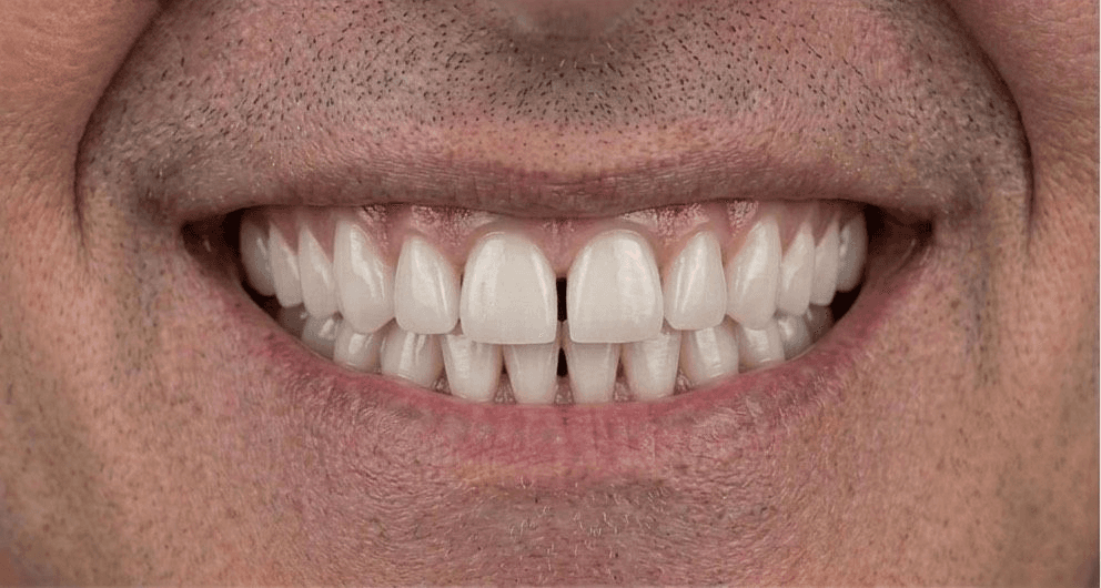 Before veneer treatment