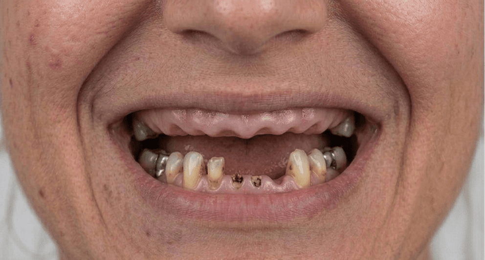 After veneer treatment