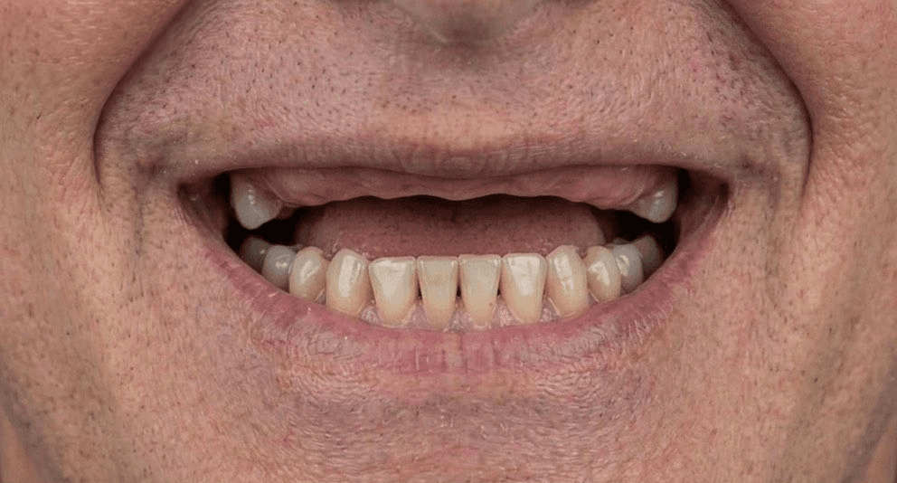 After veneer treatment