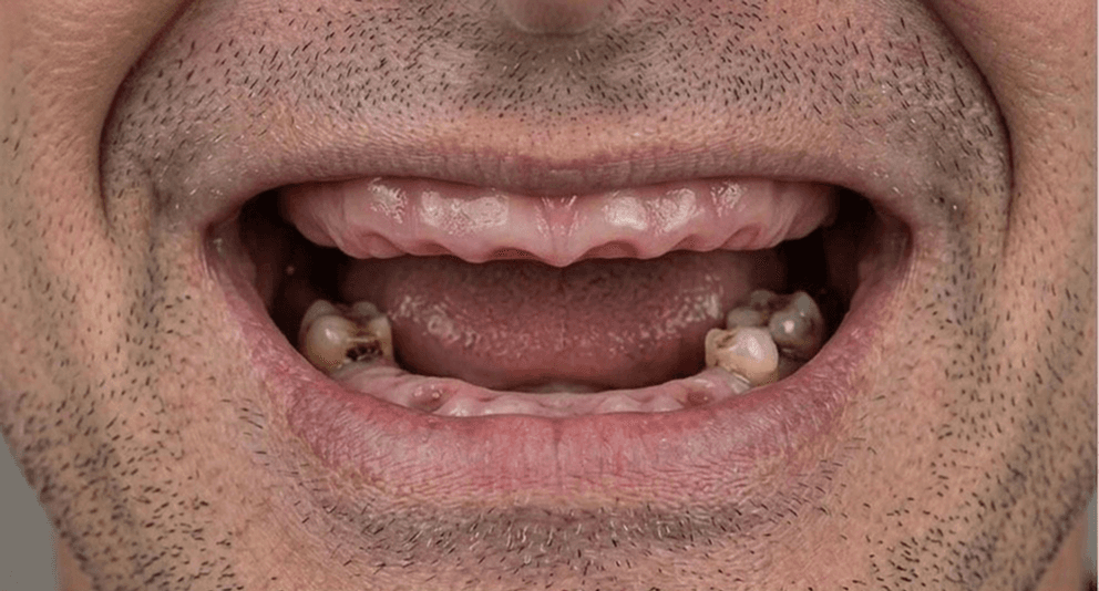 After veneer treatment
