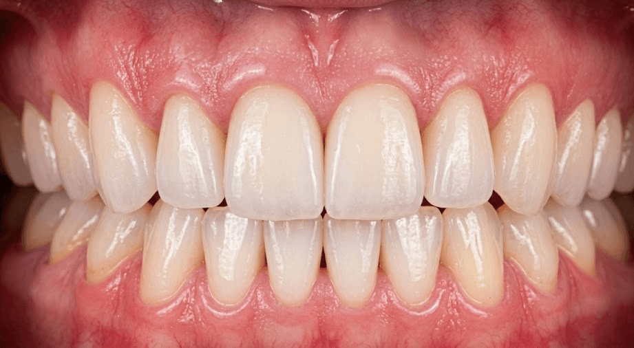 Before veneer treatment