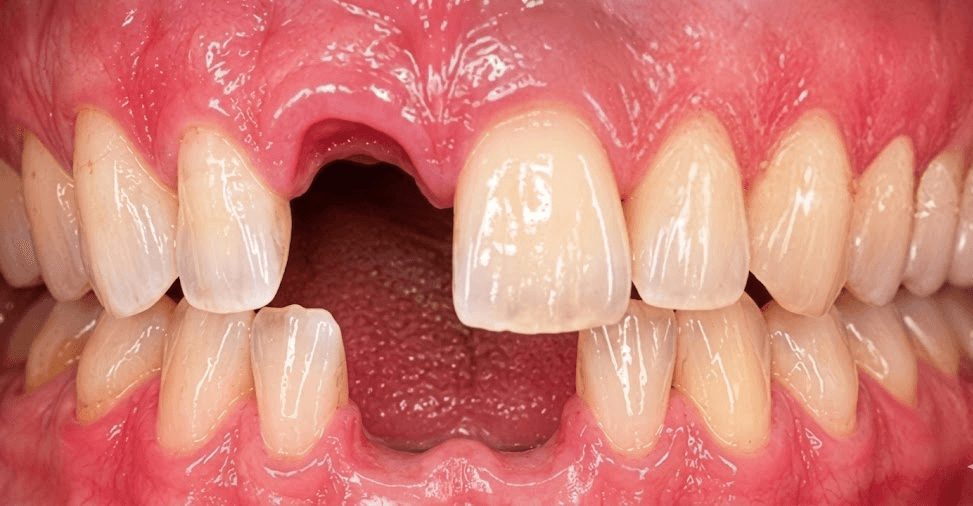 After veneer treatment