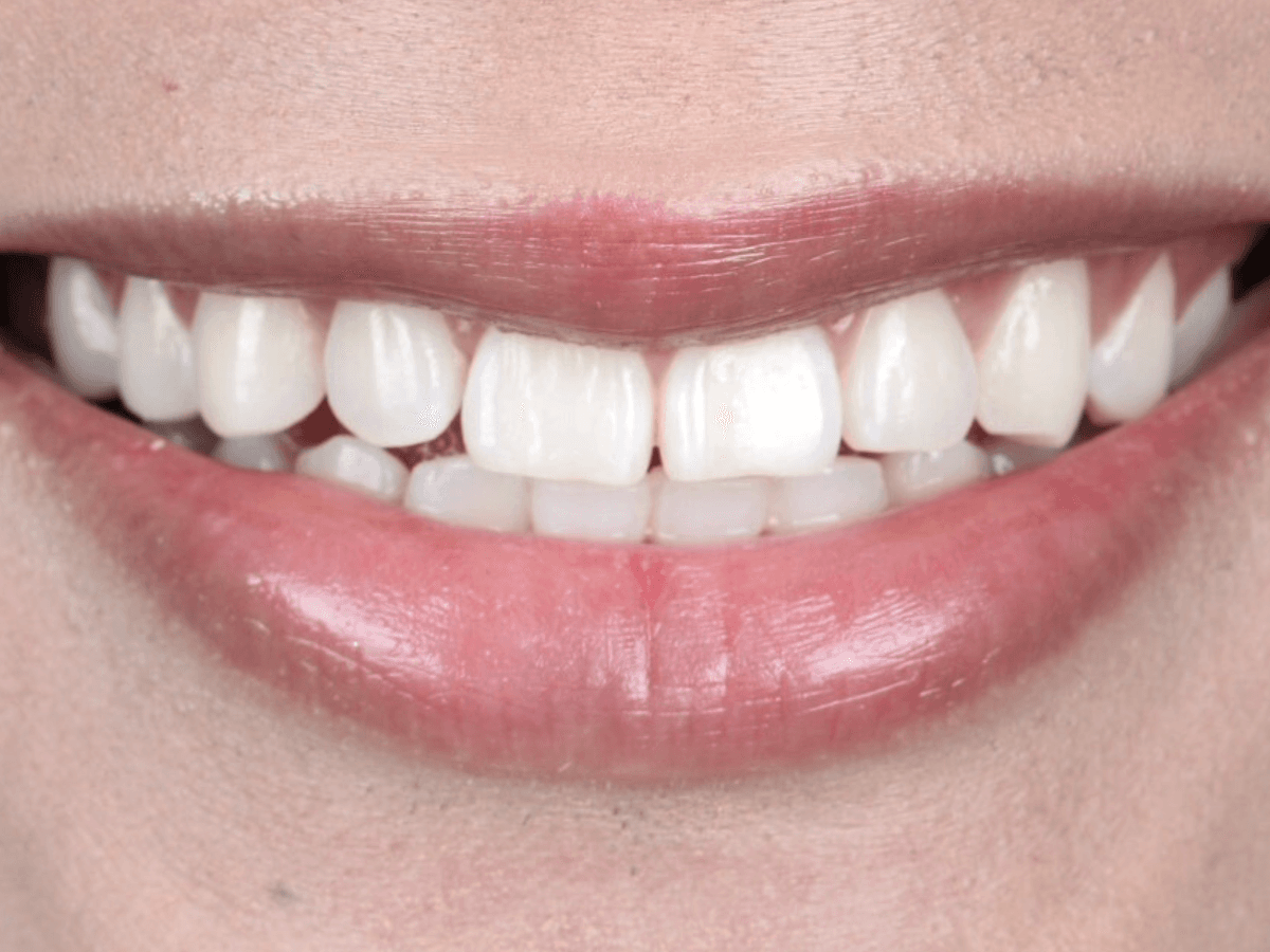After veneer treatment