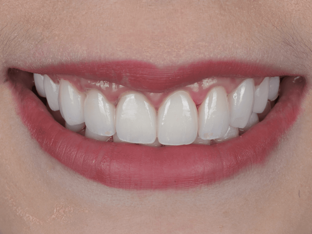 Before veneer treatment