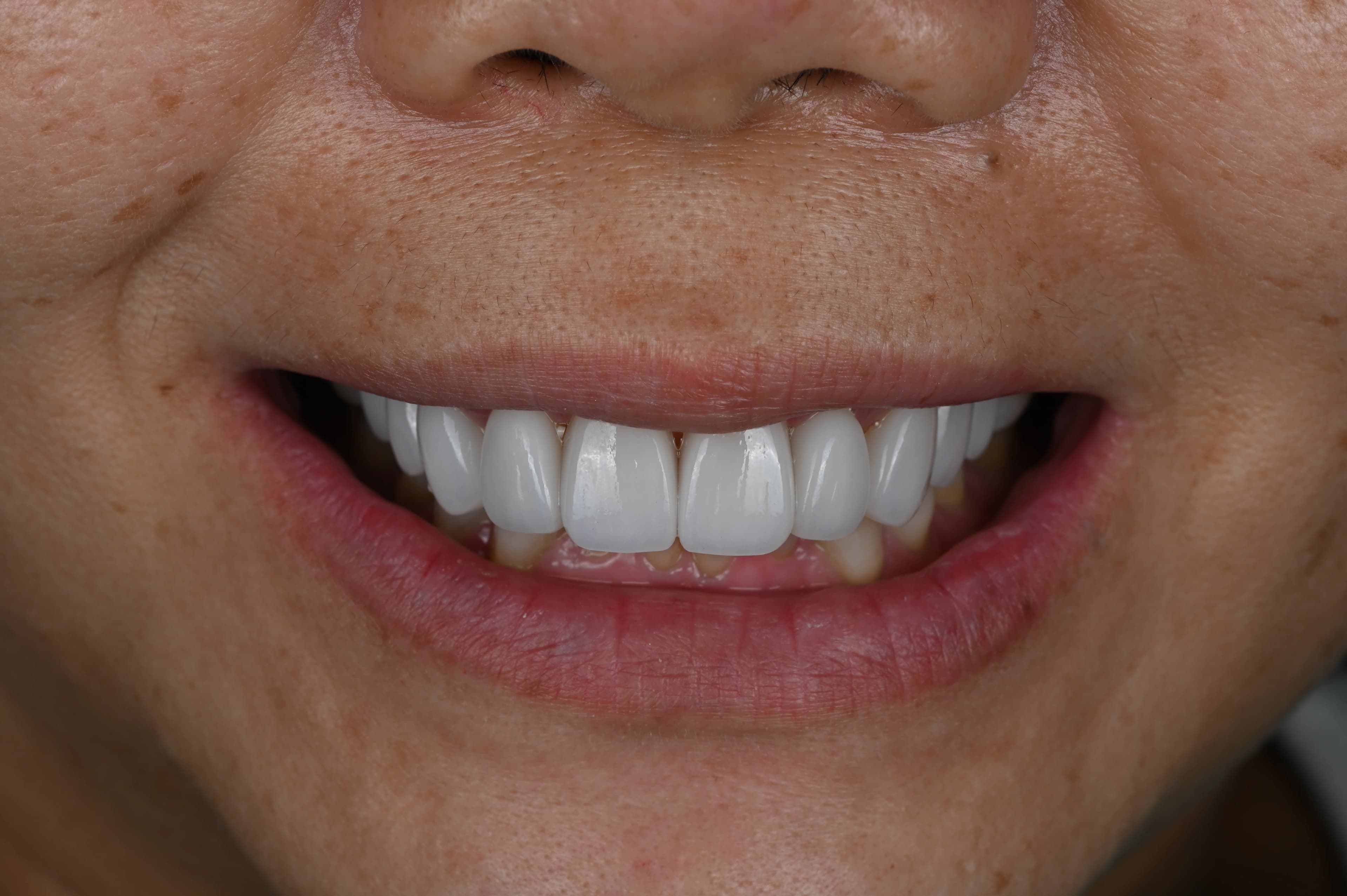 After veneer treatment