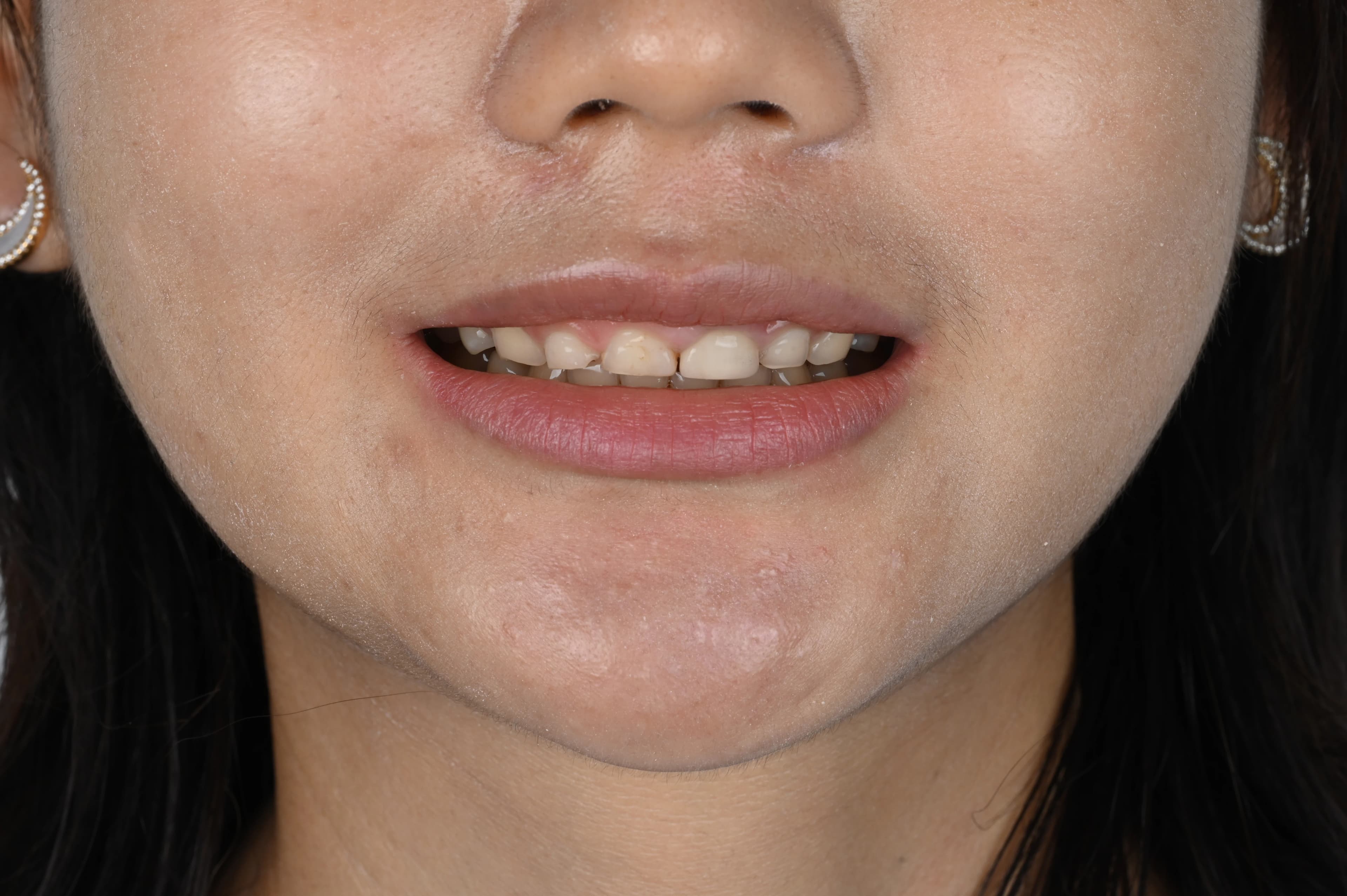 Before veneer treatment