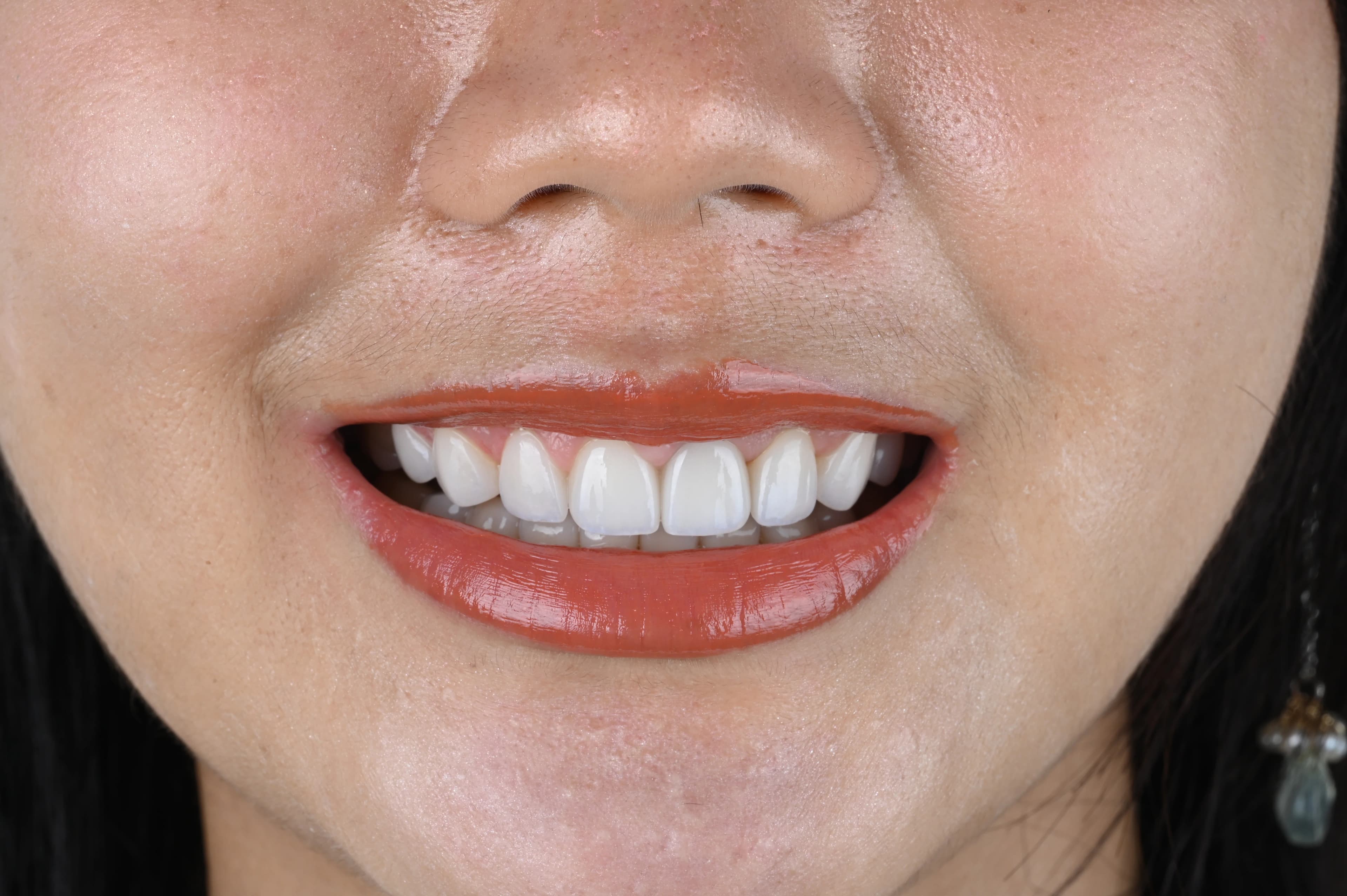 After veneer treatment