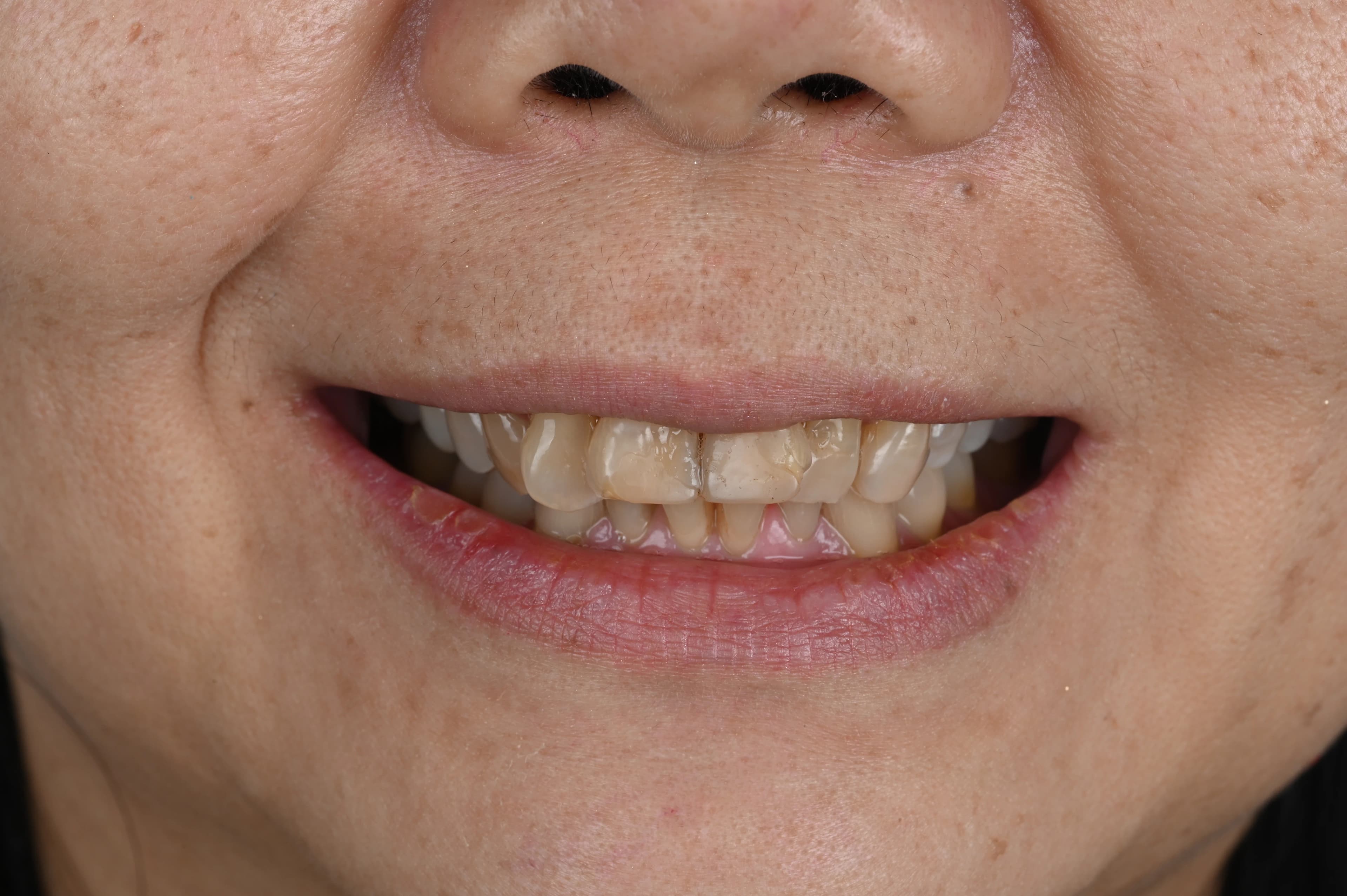Before veneer treatment
